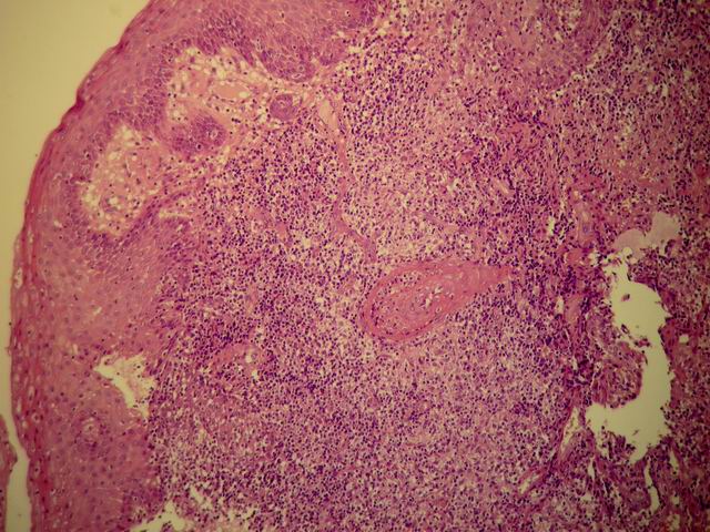 Imagen de Tumoracin larngea en paciente joven/Laryngeal tumour in young patient.