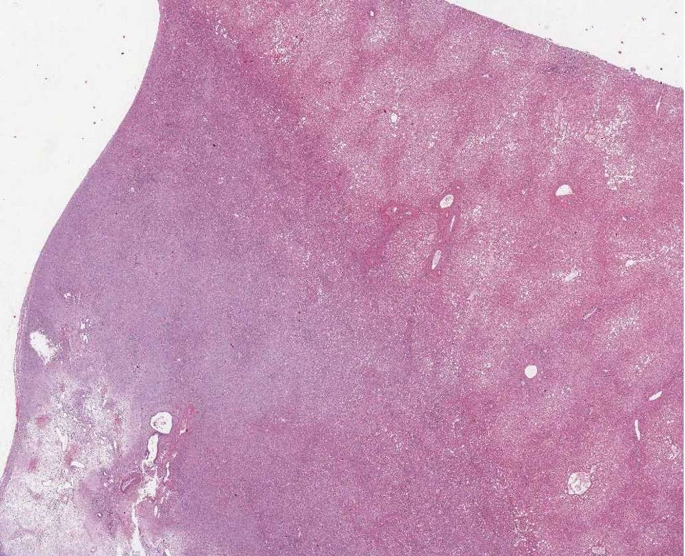 Imagen de Lesiones hepticas mltiples/Multiple liver lesions.