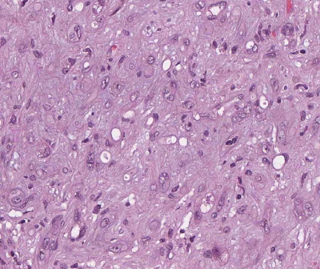 Imagen de Lesiones hepticas mltiples/Multiple liver lesions.