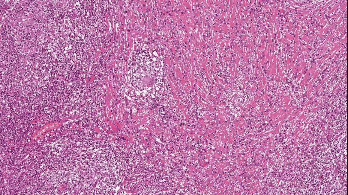 Imagen de Adenopata axilar en mujer de 60 aos/Axillary lymph node in 60 y-o female