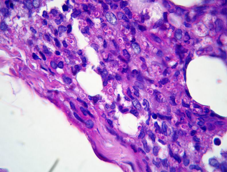Imagen de Biopsia cutnea en varn de 40 aos/Skin biopsy in 40 y-o male.