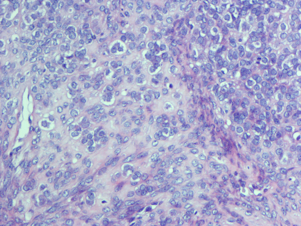 Imagen de Tumor subcutneo y de partes blandas en mujer de 73 aos/Subcutaneous soft tissue tumour in 73 y-o female
