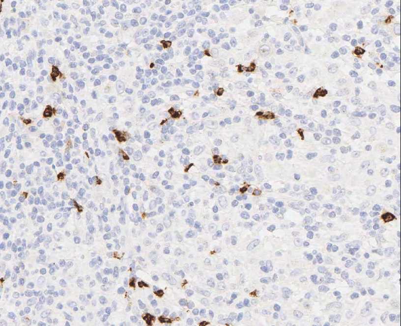 Imagen de Adenopata axilar en mujer de 60 aos/Axillary lymph node in 60 y-o female
