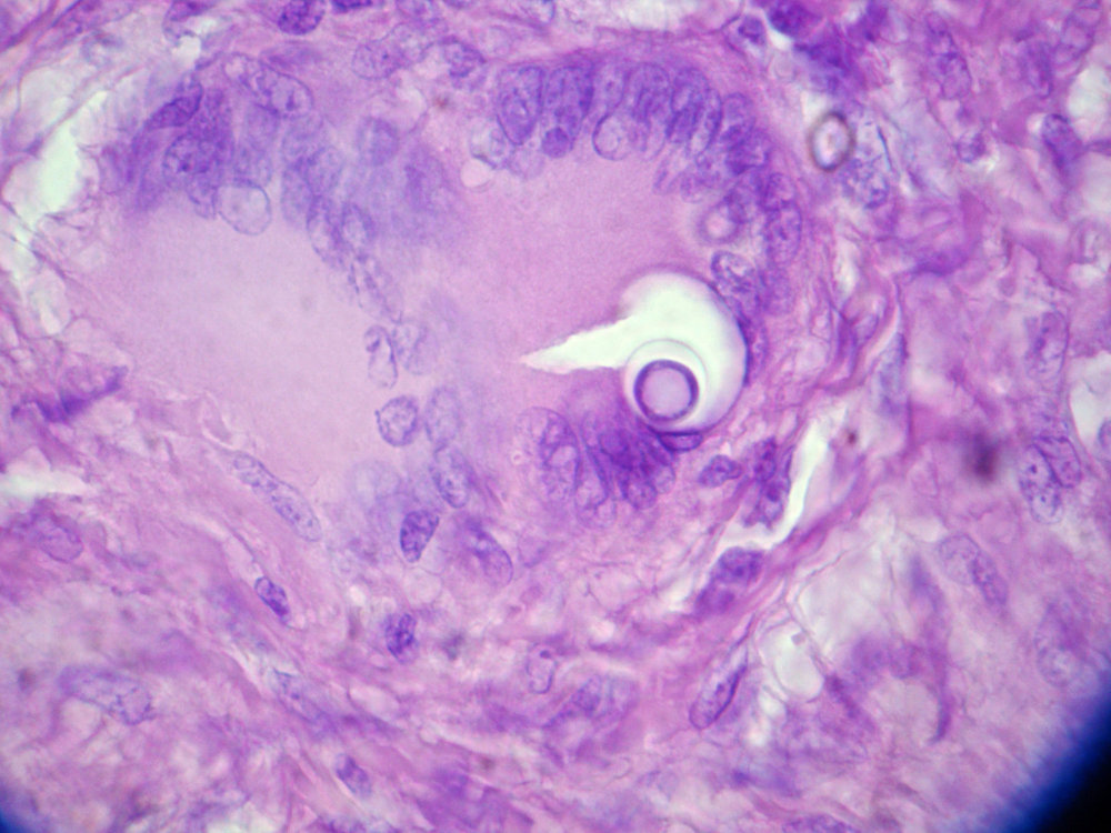 Imagen de Biopsia de ganglio linftico cervical / Cervical lymph node biopsy