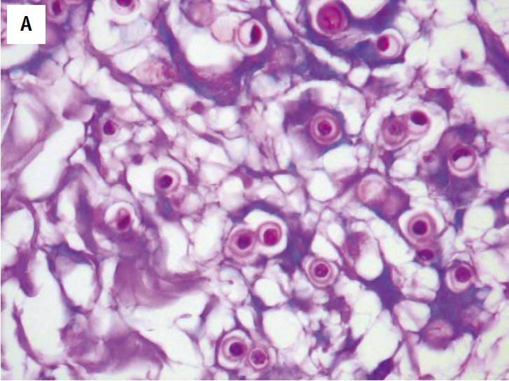 Imagen de Biopsia cutnea en varn de 40 aos/Skin biopsy in 40 y-o male.