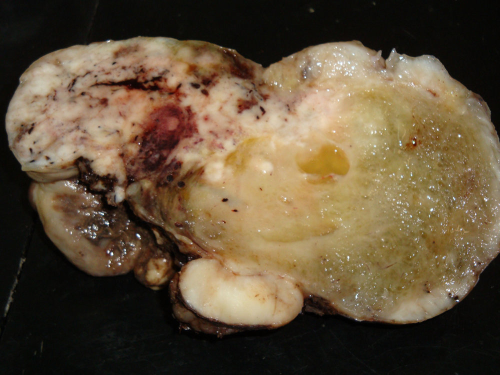 Imagen de Tumor mesentrico en mujer de 47 aos/Mesenteric tumour in 47 y-o female