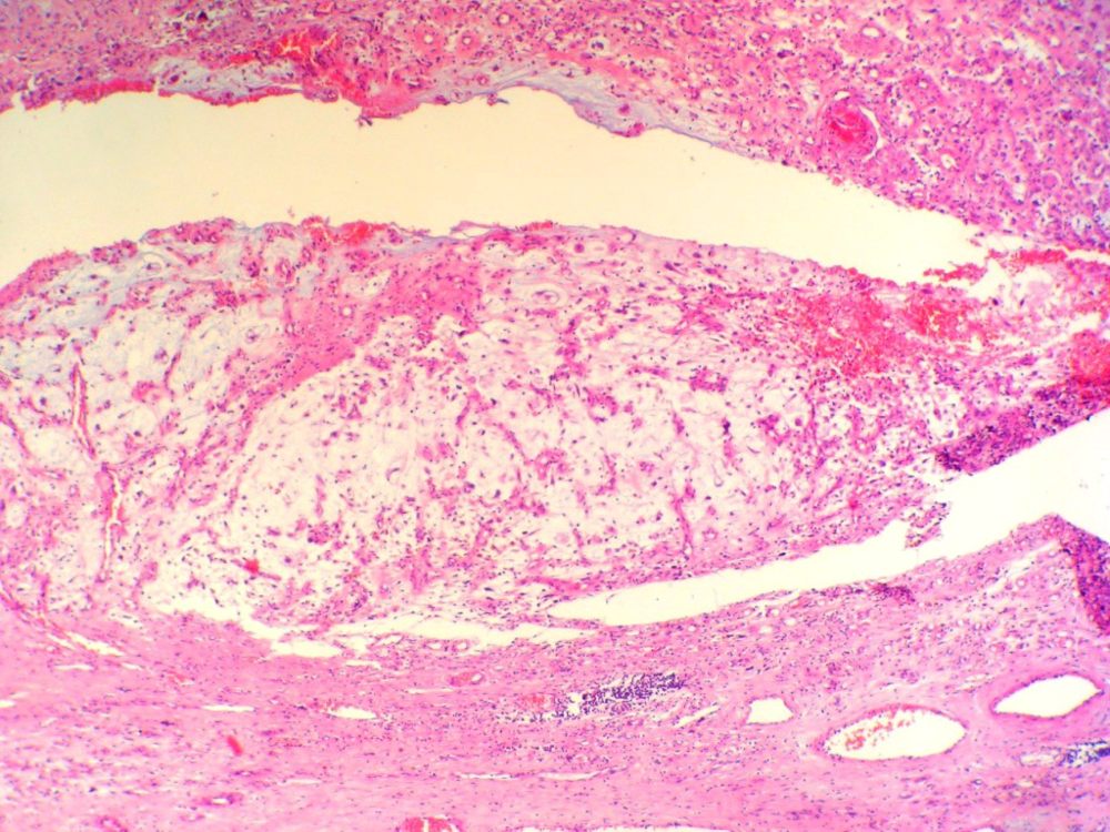 Imagen de Tumor de partes blandas en mujer de 64 aos de edad. /Soft tissue tumor in a 64 years-old woman.