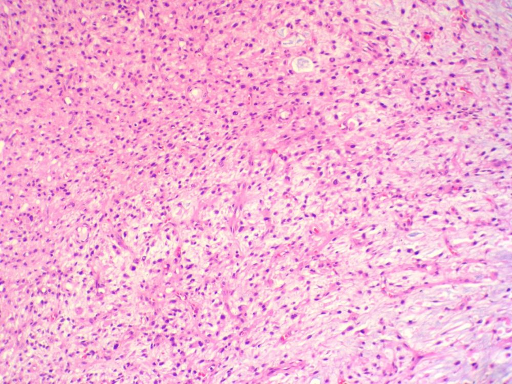 Imagen de Tumor de partes blandas en mujer de 64 aos de edad. /Soft tissue tumor in a 64 years-old woman.