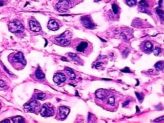 Imagen de Tumor uterino