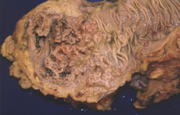 Imagen de Tumor en colon