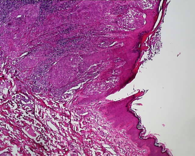 Imagen de Lesión melanocítica en espalda