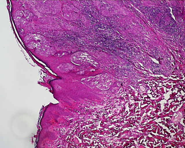 Imagen de Lesión melanocítica en espalda