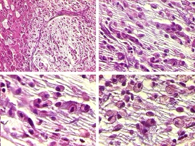 Imagen de nodulo heptico em mulher
