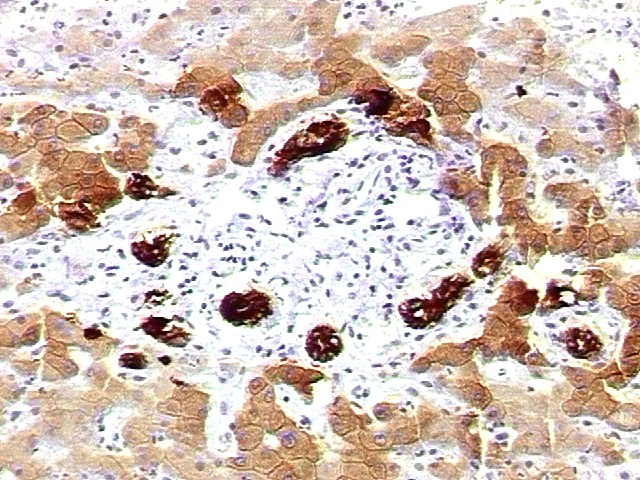 Imagen de nodulo heptico em mulher