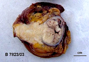 Imagen de Tumor de colon em  mulher de 21 anos