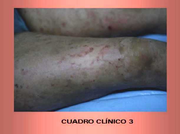 Imagen de Lesiones eritematosas y pruriginosas en mujer de 36 aos