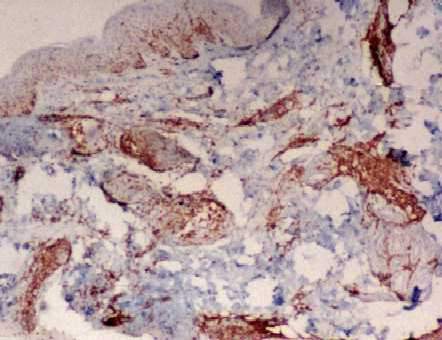 Imagen de Lesiones eritematosas y pruriginosas en mujer de 36 aos