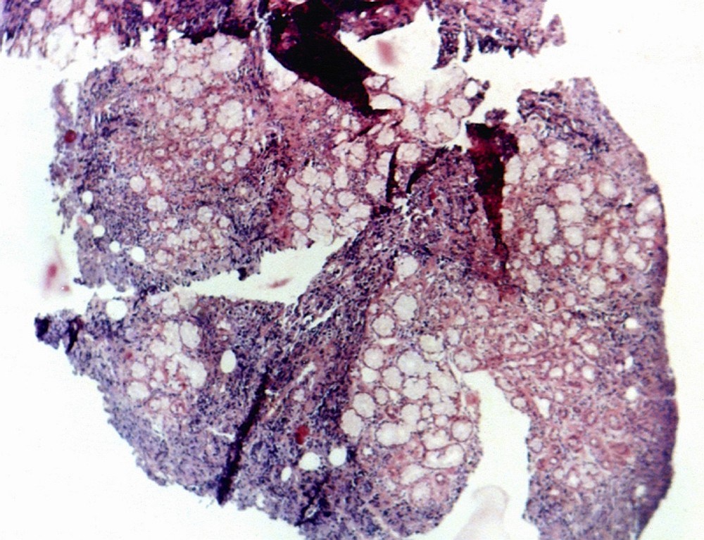 Imagen de Tumor de cavidad oral.