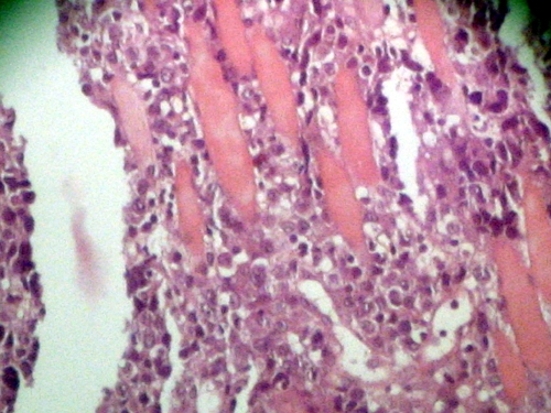 Imagen de Tumor de cavidad oral.