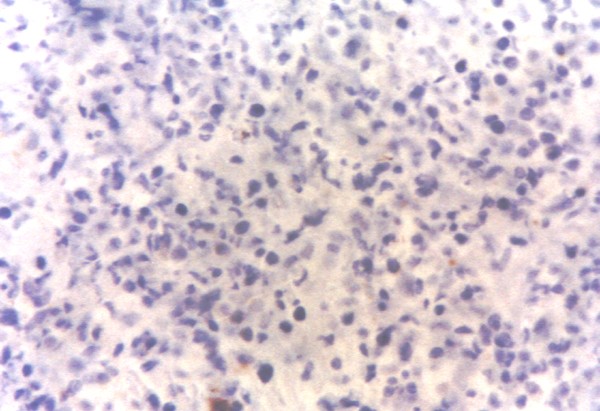 Imagen de Tumoracin escrotal en varn de 78 aos/Scrotal tumor in 78 year-old male.