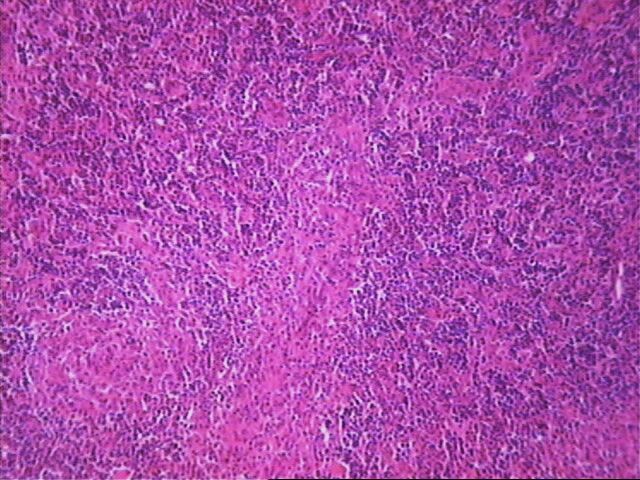 Imagen de Ganglio Linftico en varn de 60 aos con antecedentes de Linfoma de Hodgkin/Lymph node in 60 year-old male previously treated for Hodgkin disease.